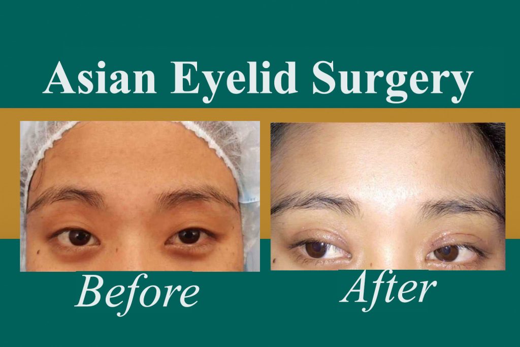 eye lid surgery before and after