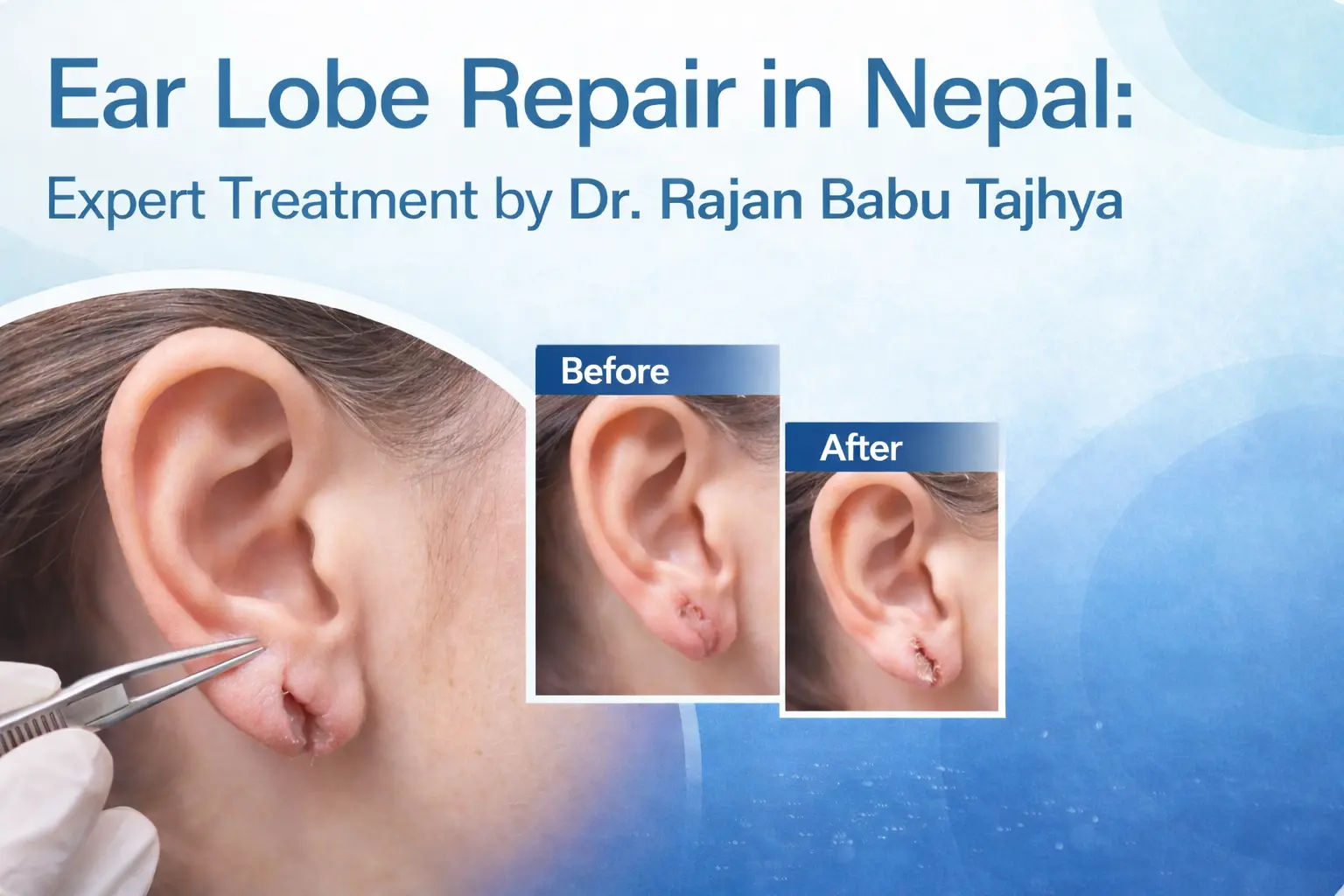 Professional ear lobe repair in Nepal by Dr. Rajan Babu Tajhya. Safe surgical procedure to fix torn, stretched earlobes. 12+ years experience