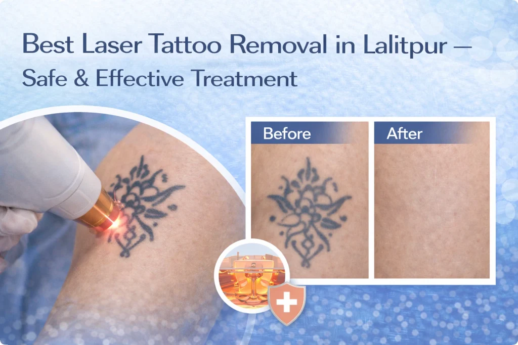Laser tattoo removal in Lalitpur, Nepal. Picosecond laser technology. Safe, effective tattoo fading & removal. Pricing from NPR 2,500.