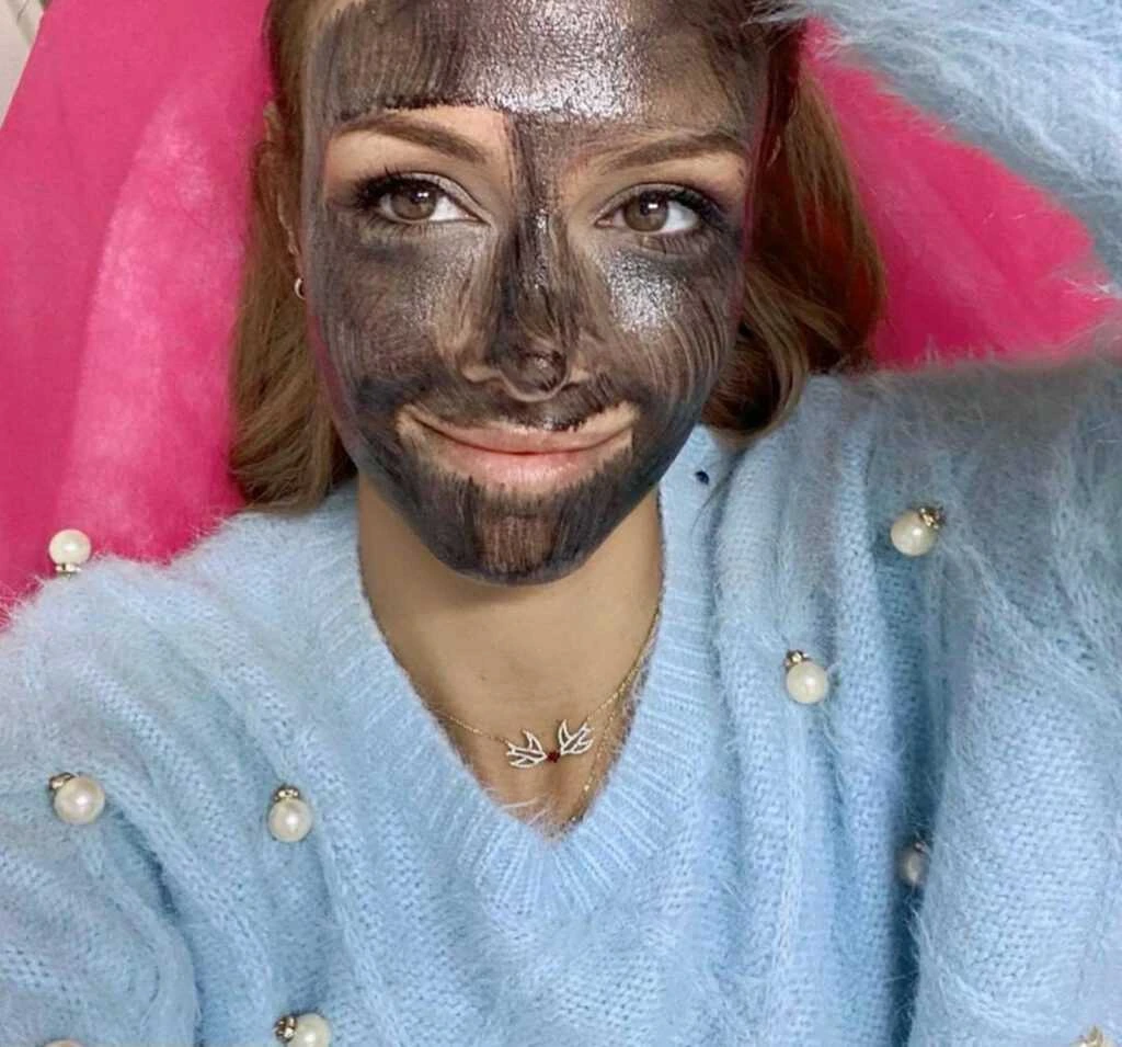 Carbon laser peel treatment being performed in a Nepalese clinic, showing a professional applying gentle laser pulses over the skin with a carbon lotion applied beforehand. The image highlights the non-invasive procedure that helps reduce acne, unclog pores, and improve overall skin texture.