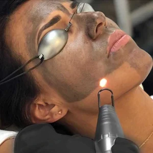 Close-up image of a Charcoal Laser Facial procedure being performed in Nepal, showing a skincare professional using a laser device on a client’s face for deep cleansing, skin rejuvenation, and detoxification.