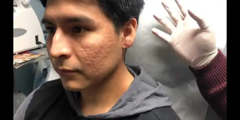 Close-up image of a face showing deep acne scars with visible pitted and uneven skin texture. The scars appear as depressions and indentations on the cheeks, highlighting the severity of atrophic acne scarring and the need for professional skin treatment.