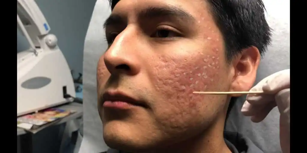 A dermatologist performing a TCA Cross procedure on a patient to treat deep acne scars. The image shows a medical professional carefully applying trichloroacetic acid directly into individual scar depressions using a fine applicator, while the patient lies comfortably in a clinical setting.