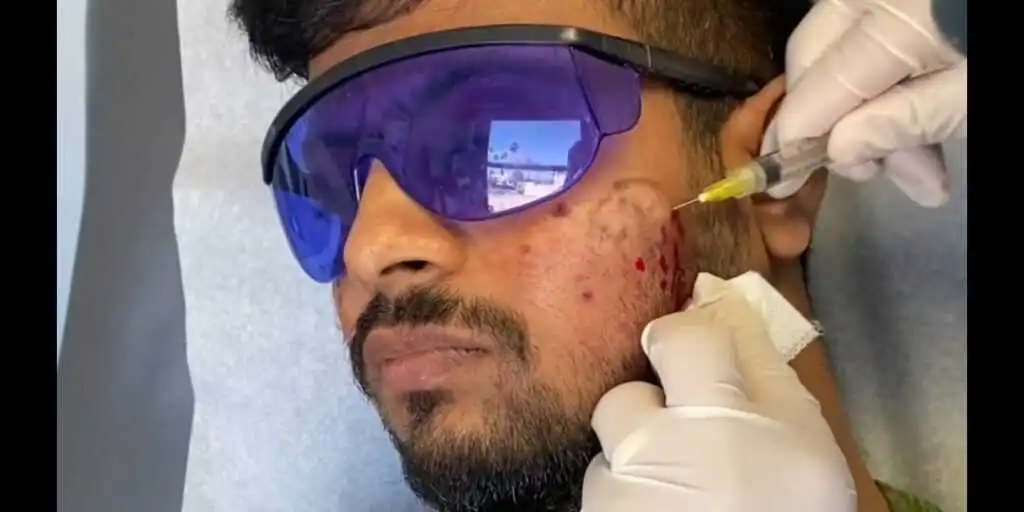 A dermatologist performing a subcision procedure on a patient to treat deep acne scars. The image shows a medical professional inserting a fine needle beneath the skin to break fibrous scar bands, helping release depressed scars and improve skin texture in a clinical setting.