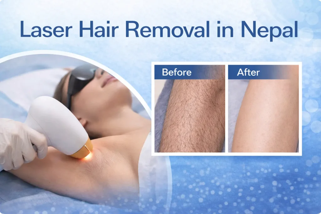 Professional laser hair removal in Lalitpur, Nepal using FDA-approved Milesman quadruple wavelength technology. Safe for all skin types.