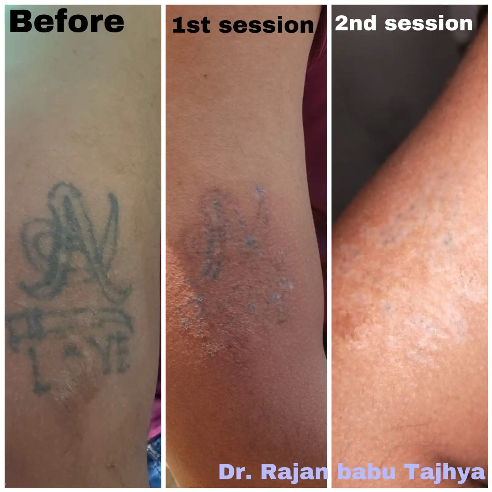 Before and after comparison of laser tattoo removal after the 2nd session. The “before” image shows a dark and clearly visible tattoo, while the “after” image reveals noticeable fading of the ink, lighter pigment, and early signs of tattoo breakdown with smoother-looking skin.