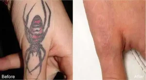 Before and after comparison of laser tattoo removal after the 6th session. The “before” image shows a dark and prominent tattoo, while the “after” image demonstrates significant fading, lighter pigment, and clearer skin with minimal visible ink remaining.