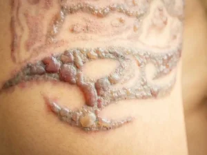 Close-up image illustrating potential side effects of laser tattoo removal, including temporary redness, mild swelling, slight blistering, and skin sensitivity in the treated area. The skin appears irritated but intact, demonstrating common short-term reactions after a laser session.