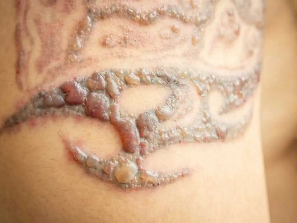 Close-up image illustrating potential side effects of laser tattoo removal, including temporary redness, mild swelling, slight blistering, and skin sensitivity in the treated area. The skin appears irritated but intact, demonstrating common short-term reactions after a laser session.
