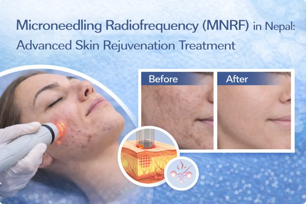 MNRF treatment in Nepal, Lalitpur for acne scars, skin tightening & wrinkles. Combines microneedling + RF energy. Safe for all skin types.