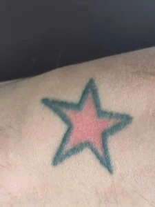 Sample 1 showing a small and simple tattoo design that is easier to remove with laser treatment. Due to its minimal size and uncomplicated ink pattern, it typically requires fewer sessions. The approximate cost of removal is around Rs. 2,500.