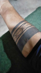 Sample 2 showing a tattoo spread over a wider area of the skin, indicating that multiple laser sessions may be required for effective removal. Due to the larger coverage and treatment time involved, the approximate cost of removal is estimated at Rs. 10,000.