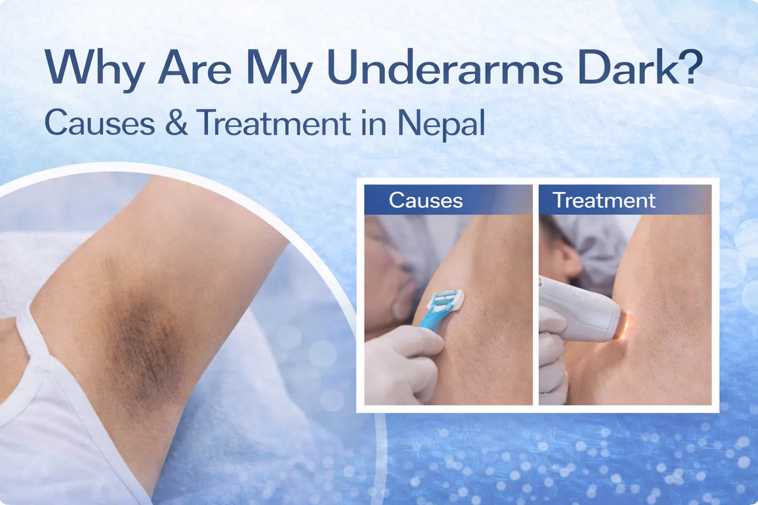 Dark underarms treatment in Lalitpur, Nepal. Learn causes (friction, post-inflammatory, insulin resistance) & solutions. Laser, peels, microneedling.