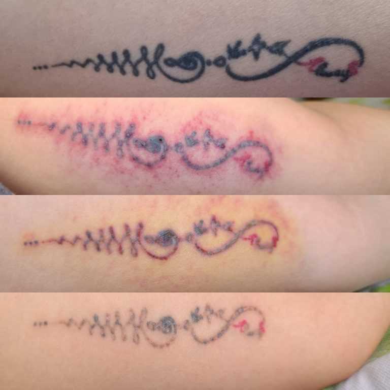 Fading vs Full Removal in laser tattoo removal explained. Learn which option suits your tattoo, skin type, and goals from expert dermatologists.