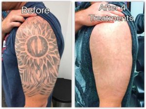 Skin Types and Laser Tattoo Removal explained: Learn how different skin tones affect tattoo removal and get expert tips for safe, effective results.